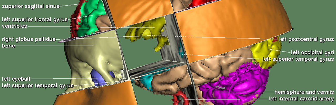 VOXEL-MAN Gallery