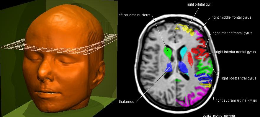 Transverse MRI sections of the brain structures