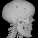 Early rendering of a skull from CT
