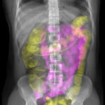 X-ray image of the torso with colored small intestine (purple) and large intestine (yellow)