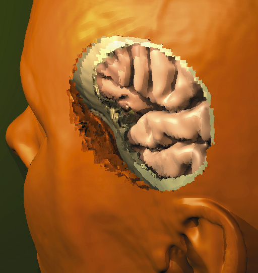 Simulating a craniotomy by pixelwise tissue removal 1992