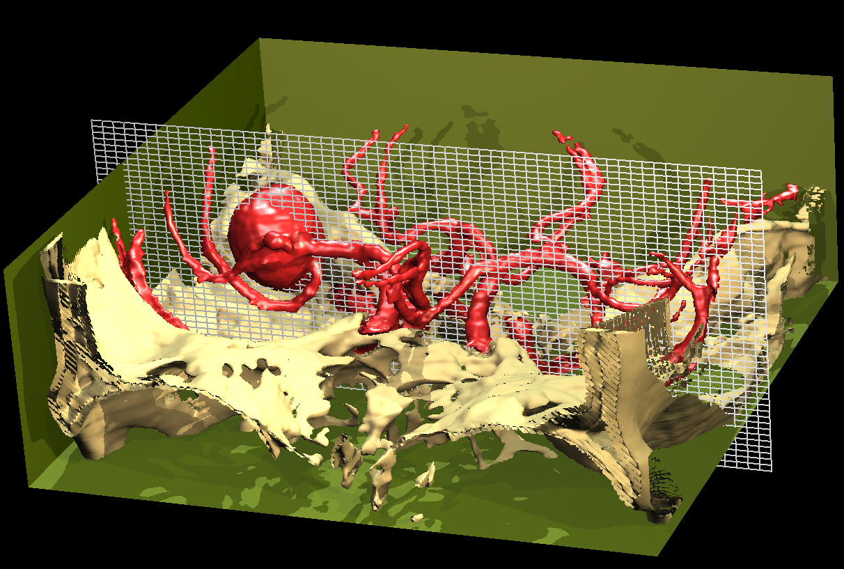 Unveiling an aneurism of the brain 1994