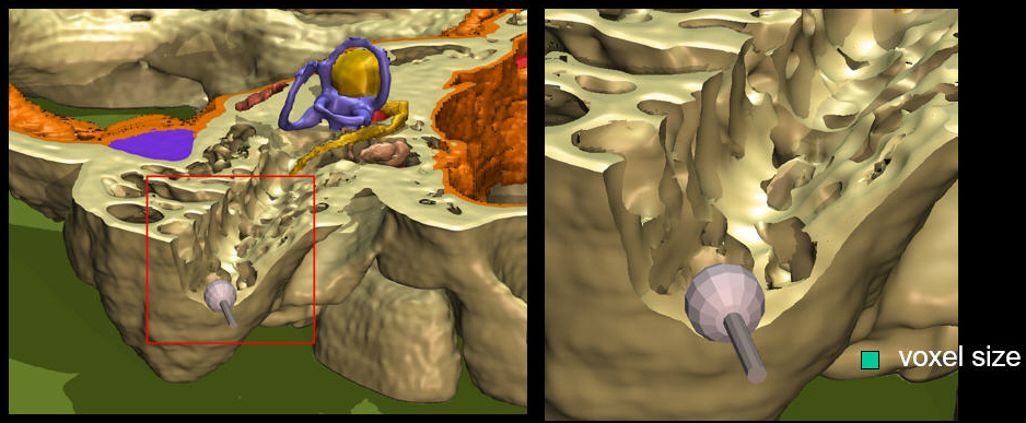 Access to the middle ear through the mastoid by drilling with the VOXEL-MAN ENT Simulator 2003