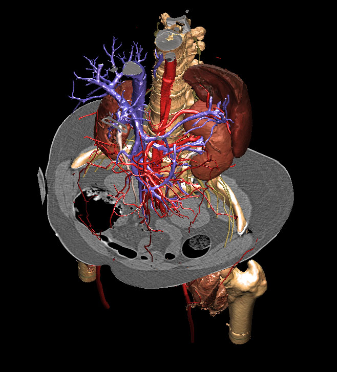 VOXEL-MAN/Inner Organs Atlas: CT-cross-sections can be placed anywhere in the 3D model