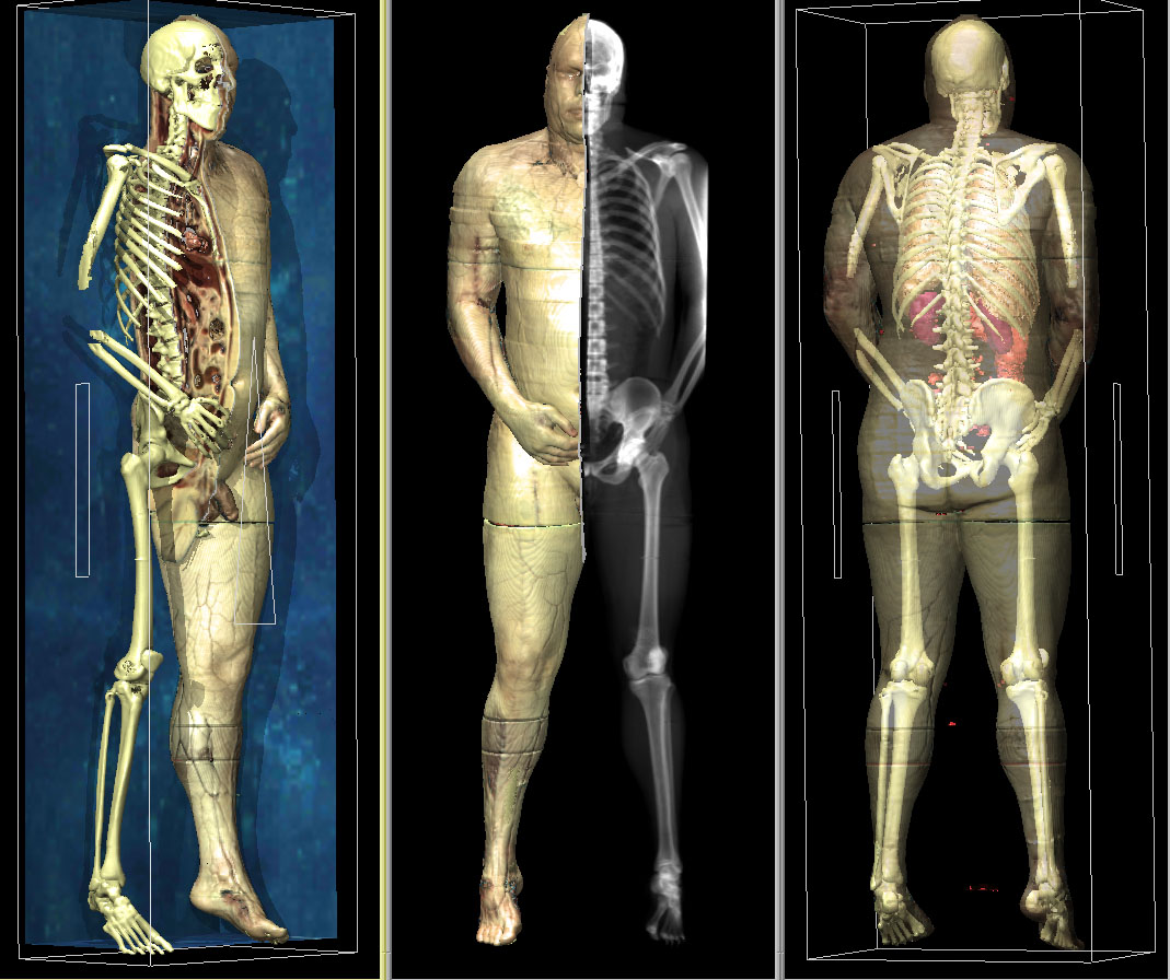 Different renderings of the Visible Human created with the VOXEL-MAN system